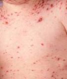 Bệnh thủy đậu ( Chickenpox)