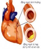 Bệnh Xơ vữa động mạch ở người cao tuổi  