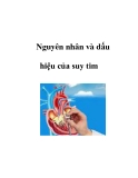 Nguyên nhân và dấu hiệu của suy tim  