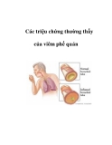 Các triệu chứng thường thấy của viêm phế quản 