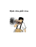 Bệnh viêm phổi virus  