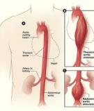 BỆNH PHÌNH ĐỘNG MẠCH CHỦ BỤNG DƯỚI