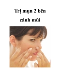 Trị mụn 2 bên cánh mũi