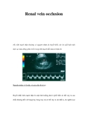 Renal vein occlusion 