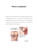 What is achalasia? 