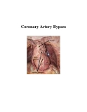 Coronary Artery Bypass 