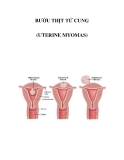 BƯỚU THỊT TỬ CUNG (UTERINE MYOMAS 