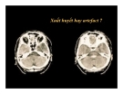 CT Scan trong tai biến mạch máu não  part 2