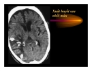 CT Scan trong tai biến mạch máu não  part 3