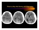 CT Scan trong tai biến mạch máu não  part 4