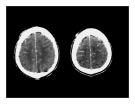 CT Scan trong tai biến mạch máu não  part 5