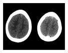 CT Scan trong tai biến mạch máu não  part 7