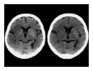 CT Scan trong tai biến mạch máu não  part 9