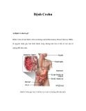 Bệnh Crohn 