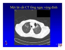 Bài giảng điều trị HIV : Các hội chứng hô hấp trong nhiễm HIV part 6