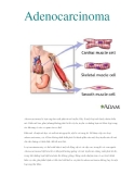 Adenocarcinoma  