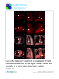 Báo cáo khoa học: "Successful radiation treatment of anaplastic thyroid carcinoma metastatic to the right cardiac atrium and ventricle in a pacemaker-dependent patient"