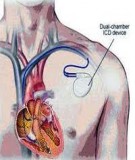 Bệnh Học Thực Hành: Suy tim (Insufisance cardiaque - Congestive heart failure – Tâm Lực Suy Kiệt)