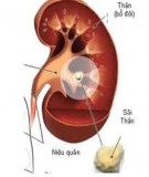 Tài liệu Bệnh Học Thực Hành: Sỏi thận (sạn thận)