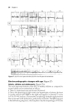 Basic Electrocardiography Normal and abnormal ECG patterns - Part 3