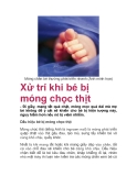  Xử trí khi bé bị móng chọc thịt