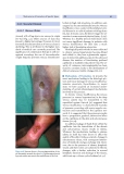 Wound Healing and Ulcers of the Skin - part 3
