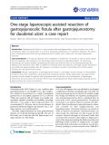 báo cáo khoa học: "One-stage laparoscopic-assisted resection of gastrojejunocolic fistula after gastrojejunostomy for duodenal ulcer: a case report"