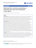 Báo cáo y học: "Adrenocortical carcinoma presenting as varicocele and renal vein thrombosis: a case report."