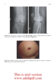 Chondral Disease of the Knee - part 2