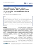 Báo cáo y học: "  Carcinoid tumor of the verumontanum (colliculus seminalis) of the prostatic urethra with a coexisting prostatic adenocarcinoma: a case report"