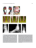 Total Ankle Arthroplasty - part 8