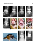 Total Ankle Arthroplasty - part 10