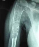X-quang xương hông