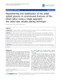 báo cáo hóa học:"  Repositioning and stabilization of the radial styloid process in comminuted fractures of the distal radius using a single approach: the radio-volar double plating technique"