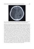 Acute Ischemic Stroke Part 11