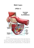 Bệnh Lupus