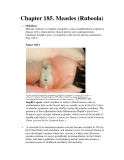 Chapter 185. Measles (Rubeola) 