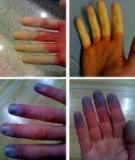 Mùa lạnh, cảnh giác với bệnh Raynaud