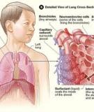 Chronic interstitial lung disease in children