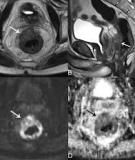 Role of diffusion-weighted imaging in the diagnosis of gynecological diseases