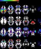White Matter Changes Compromise Prefrontal Cortex Function in Healthy Elderly Individuals