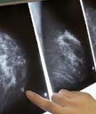 SCREENING FOR BREAST CANCER  WITH MAMMOGRAPHY     