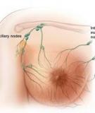 Cancer of the Female Breast