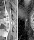 Extrapulmonary tuberculosis