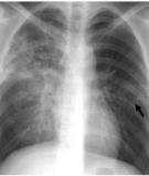 Patterns of drug resistance in pulmonary tuberculosis cases in the Izmir district, Turkey