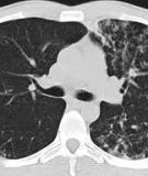 Detection of Pulmonary tuberculosis: comparing MR imaging with HRCT