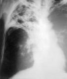 Diversity of disease in childhood pulmonary tuberculosis