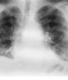 Variation of Chest Radiographic Patterns in Pulmonary Tuberculosis by Degree of Human Immunodeficiency Virus–Related Immunosuppression