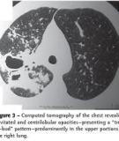 Diagnosis of pulmonary tuberculosis by smear microscopy and culture in a tertiary health care facility: Biology and Medicine
