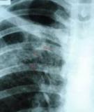 Update: The Radiographic Features of Pulmonary Tuberculosis